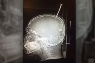 An X-ray showing the screw lodged in a teenager's skull.