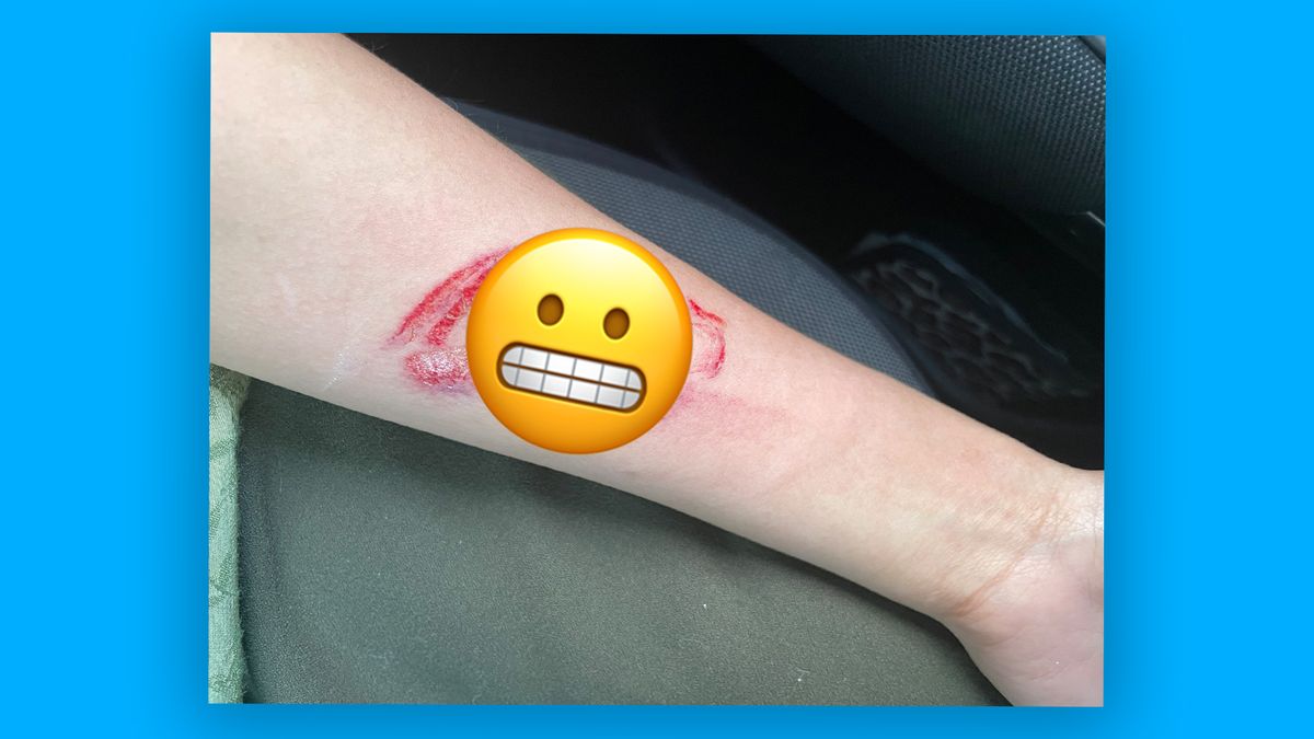 Car logo bruise with a grimacing emoji covering the injury