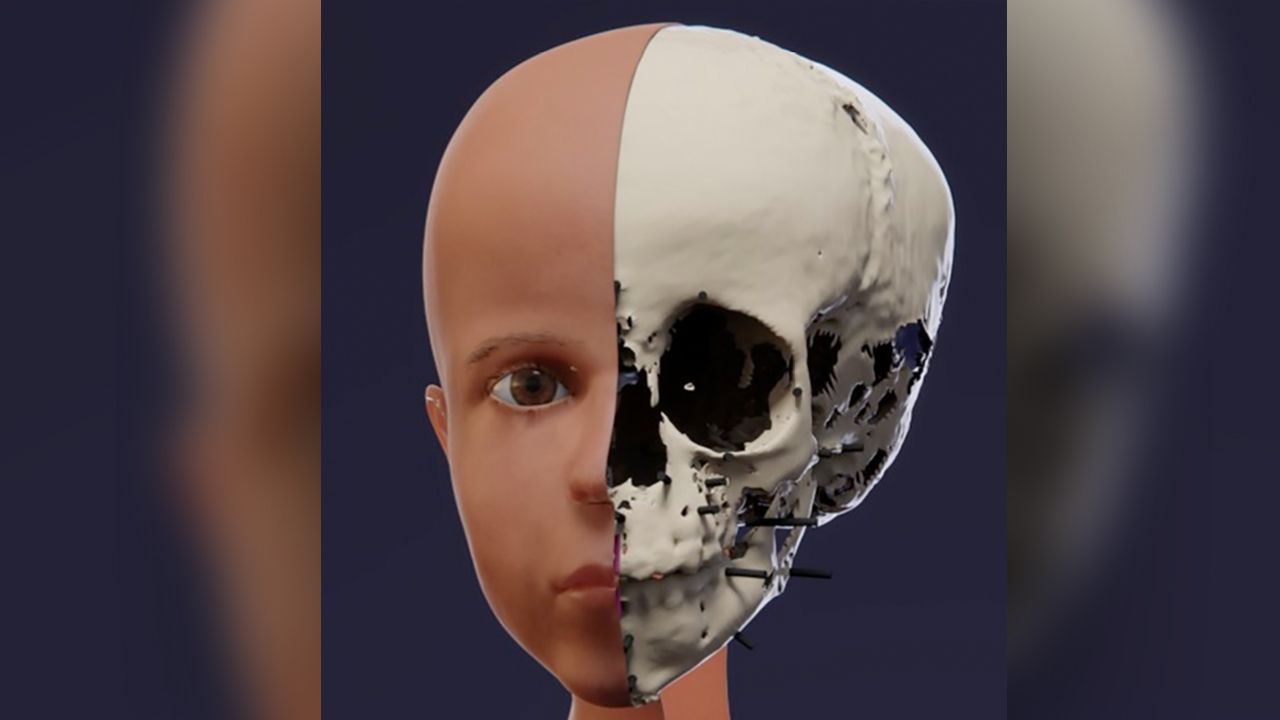 This step of the facial reconstruction shows how the scientists determined the thickness of skin on the boy's face.