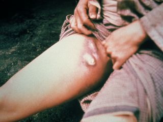 Buboes, a symptom of bubonic plague, which is blamed for the black death