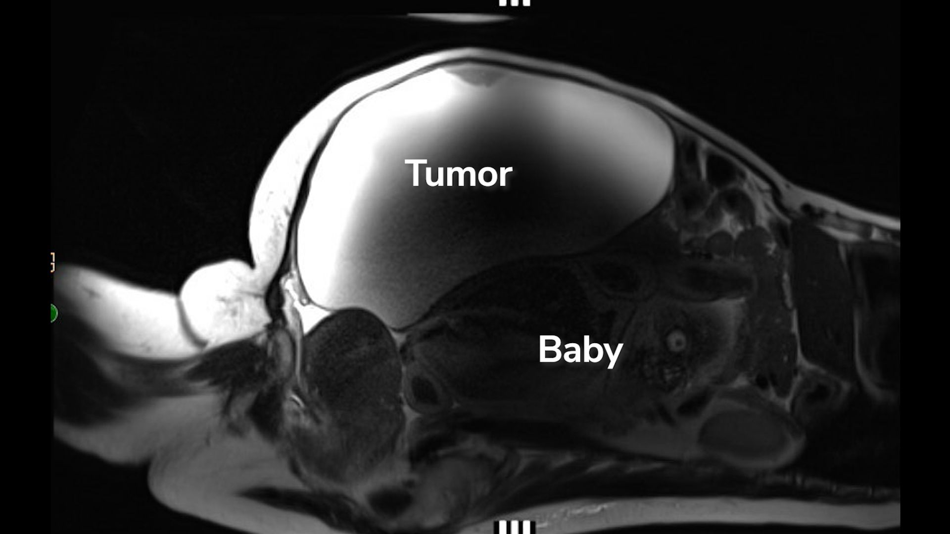 medical image shows a patient&#039;s abdomen, with a large cyst labeled &quot;tumor&quot; and an area just under the tumor labeled &quot;baby&quot;