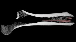 A CT scan of a femur showing splintered arrowhead fragments