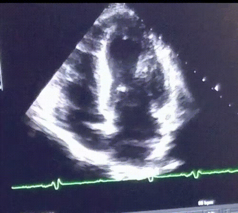 This is an echocardiogram of a 30-year-old athlete with an enlarged heart.