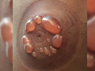 A woman developed a collection of large blisters in the shape of a circle from cupping therapy. The injury occurred because she applied the cups herself and then fell asleep, leaving the cups on for too long.