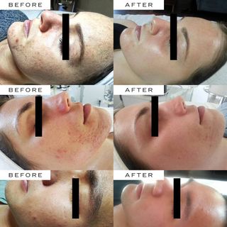 what-is-microneedling-279375-1584042744406-image
