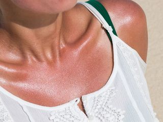 how-to-treat-sunburn-281077-1562195789905-main