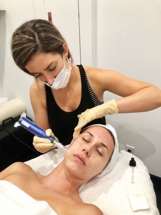 microneedling-review-282626-1569992673374-main