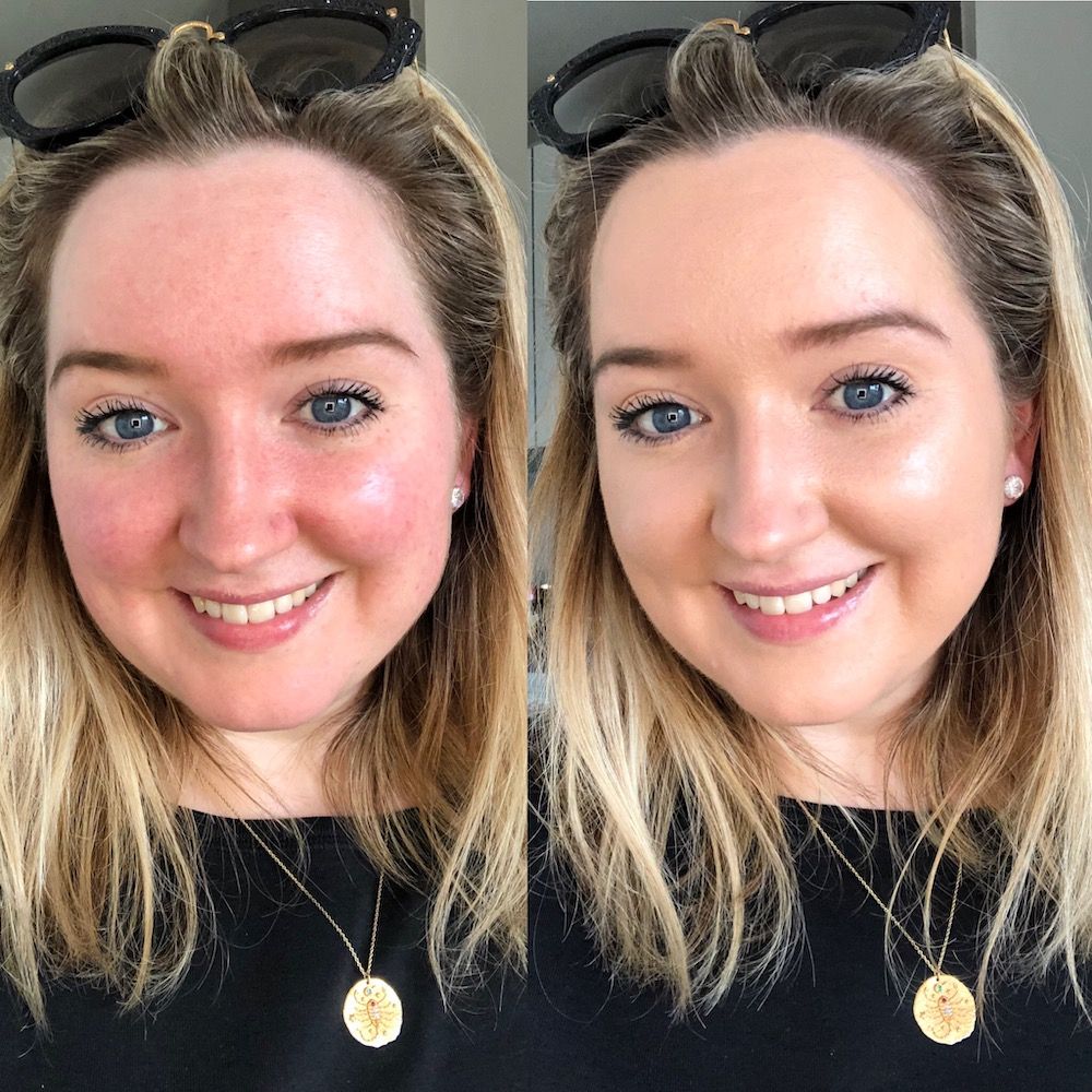 I Recommend These Products for Rosacea More Than Any Others | Who What Wear