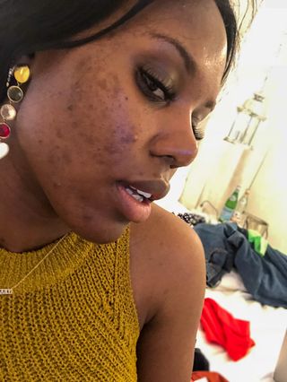 how-to-get-rid-of-acne-291778-1615374613395-main