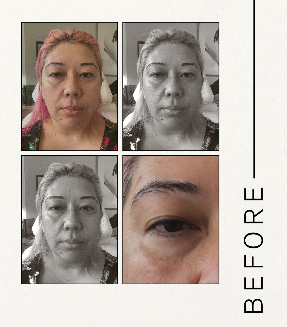 Reviewed Here S What Happened When I Got Tear Trough Filler Who What   Tear Trough Filler Review 295029 1630441498871 Main 1920 80 