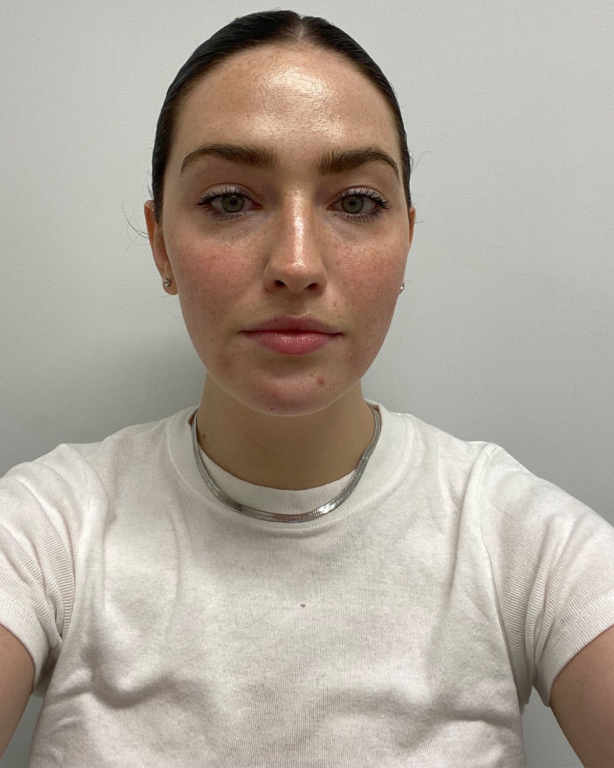 Hyaluronic Acid Fillers Benefits, Drawbacks, Cost and More Who What Wear