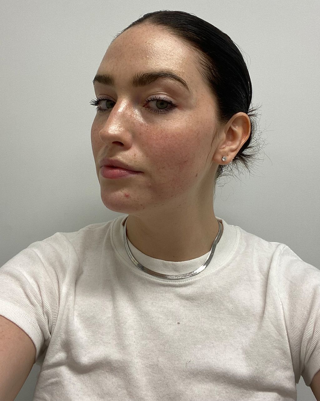 Hyaluronic Acid Fillers Benefits, Drawbacks, Cost and More Who What Wear