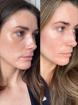 radiofrequency-microneedling-review-303430-1667407262375-image