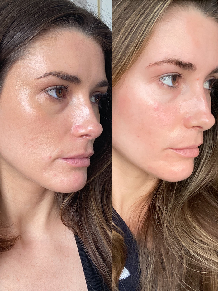 I Tried Radiofrequency Microneedling—heres My Honest Review With