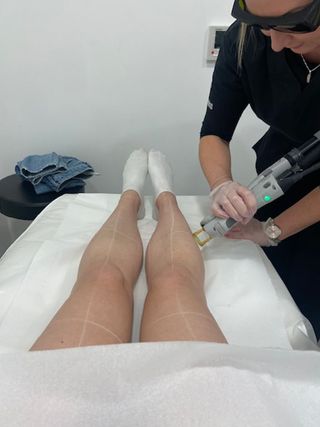 laser-hair-removal-review-307771-1686676531441-image