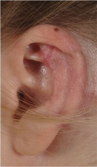 The restored ear, made in part from cartilage taken from the woman's ribs.