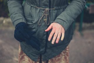 White hands are a symptom of Raynaud's.