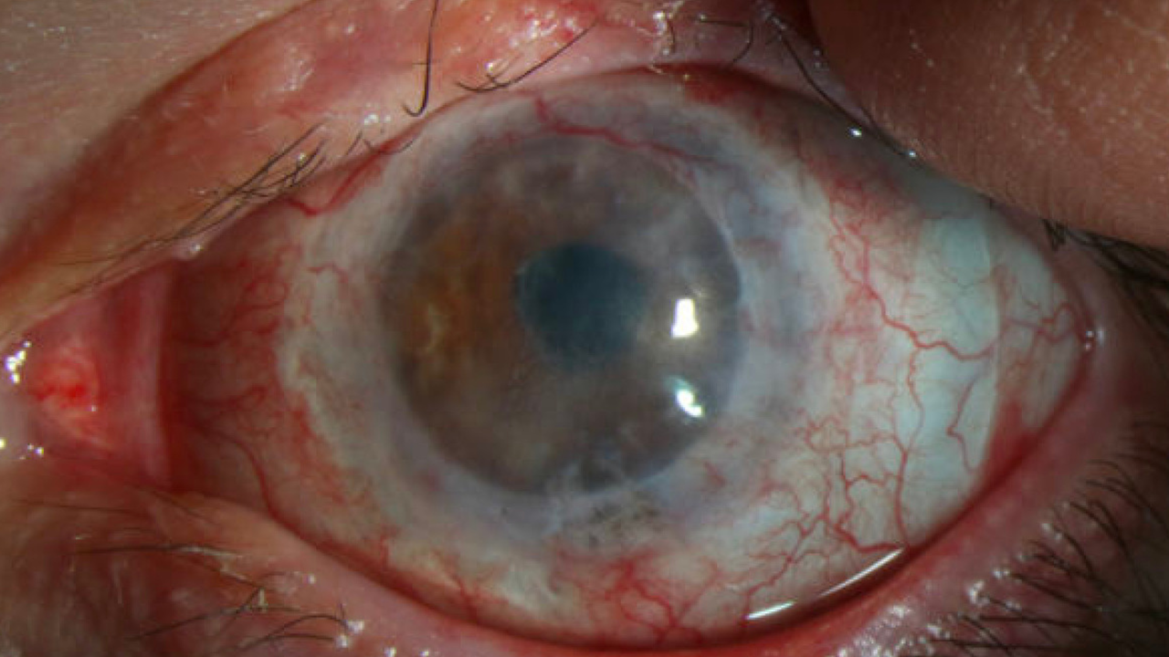 A close-up image of Nick's eye after the stem cell transplant.