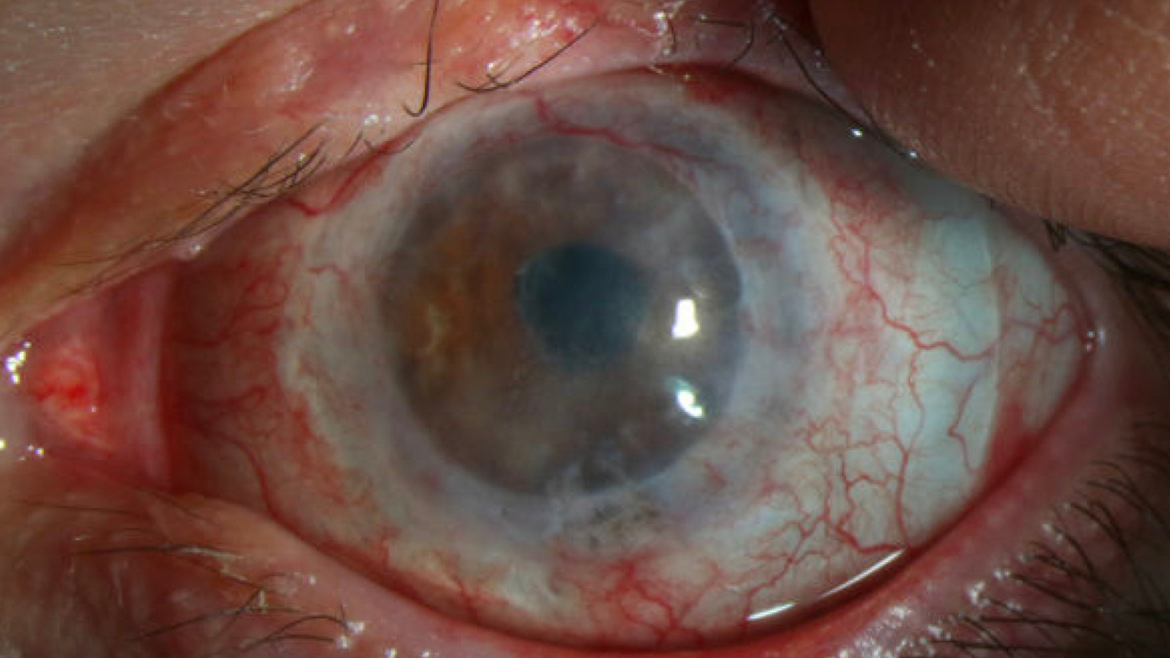 A close-up image of Nick's eye after the stem cell transplant. 