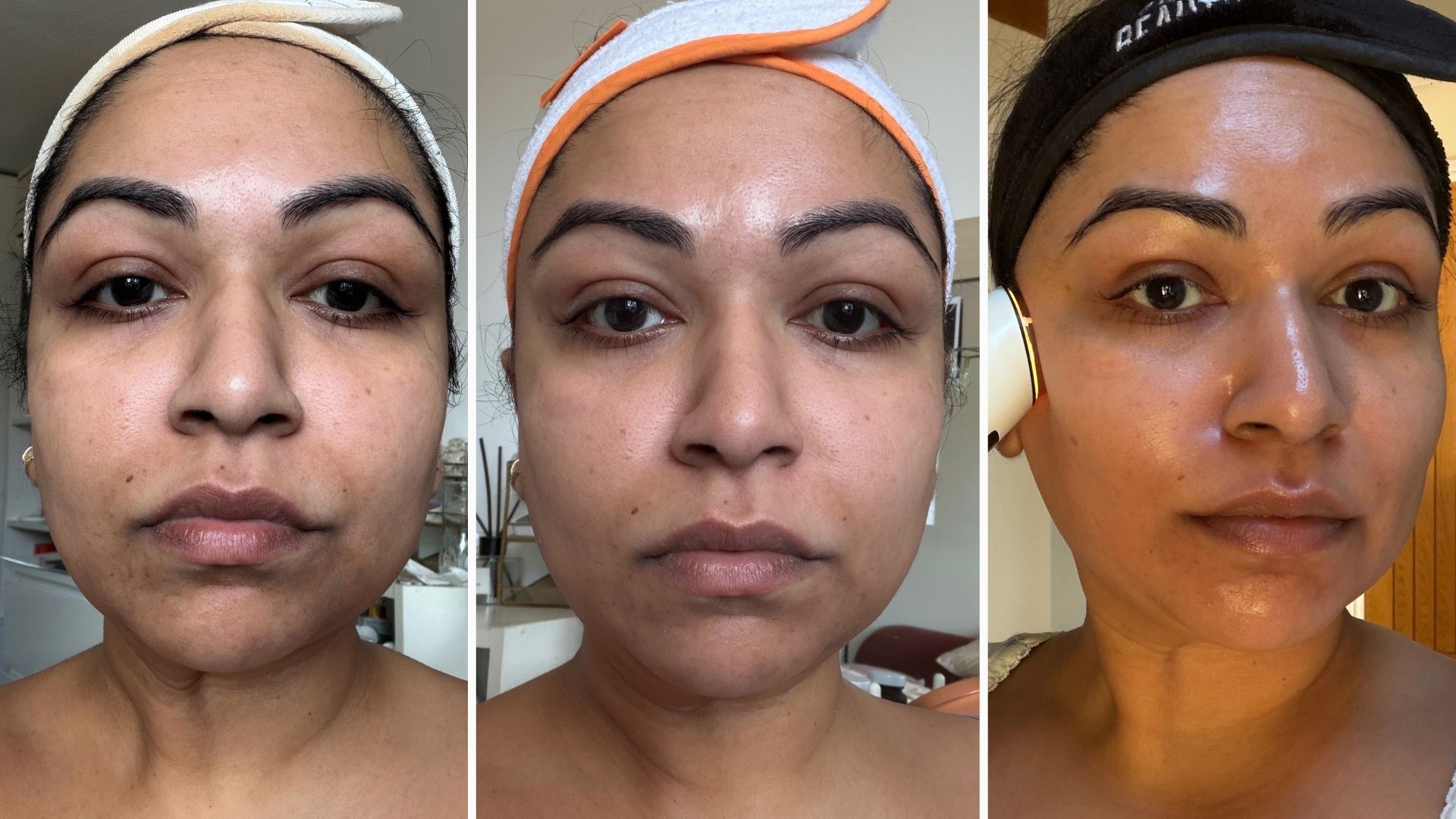 Aleesha skin before, during and after new skincare routine