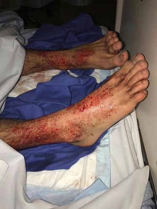 In this photo taken Aug. 5 at Sandringham Hospital in Melbourne, Australia, teenager Sam Kanizay's feet are seen covered in what looked like hundreds of bleeding pinpricks.