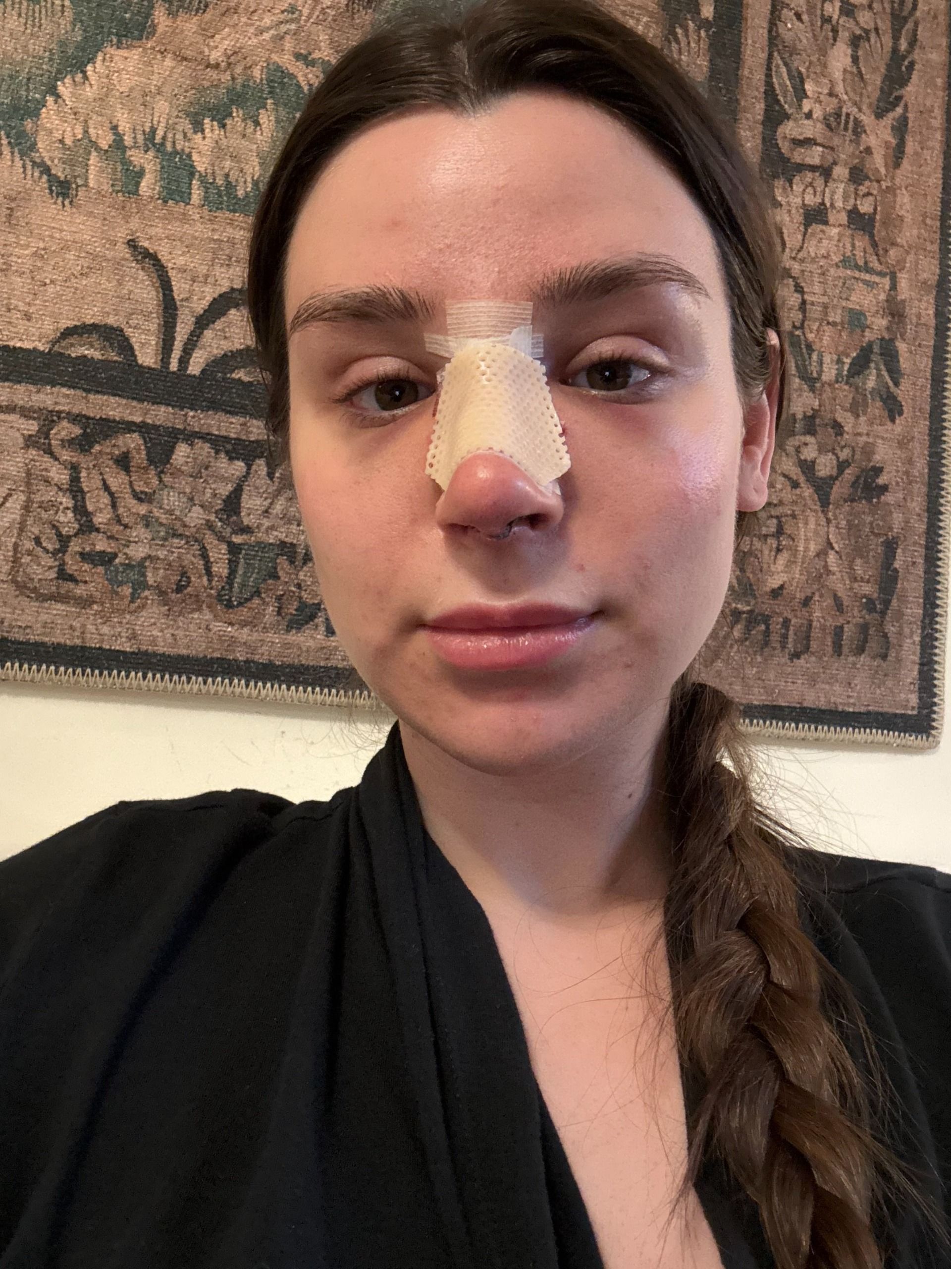 a girl post nose job recovery with a cast on