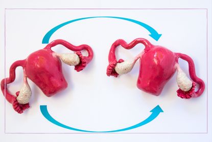 Womb transplant graphic of two wombs and arrows showing the swap
