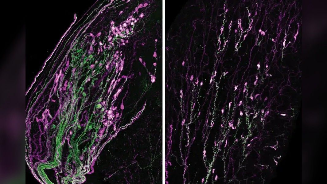 Sagittal sections of mouse clitoris (left) and mouse penis (right) stained for S100 (magenta) and tdtomato (green) showing higher density of Krause corpuscles in the clitoris. S100 is a marker for terminal Schwann cells that wrap around the nerve terminals, while tdtomato labels the sensory nerve that innervates the Krause corpuscles.