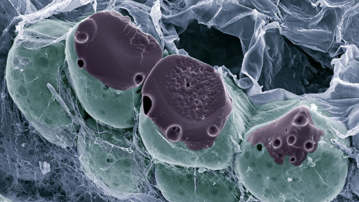 Excess adipose tissue, which stores fat and is shown here in a scanning electron microscope image, creates a mechanical compression in patients with obesity.