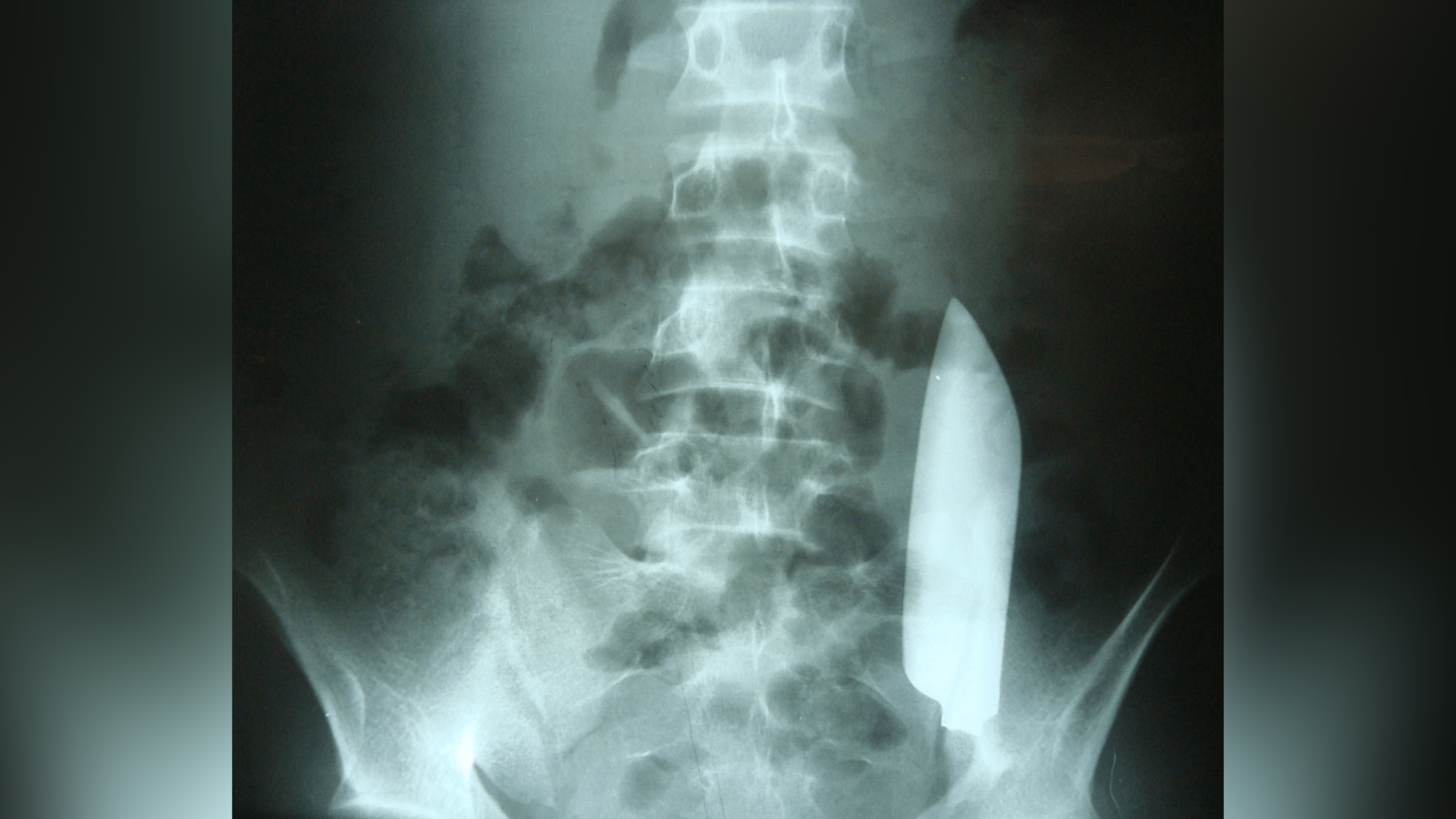 X-ray of the knife blade stuck in the man's abdomen