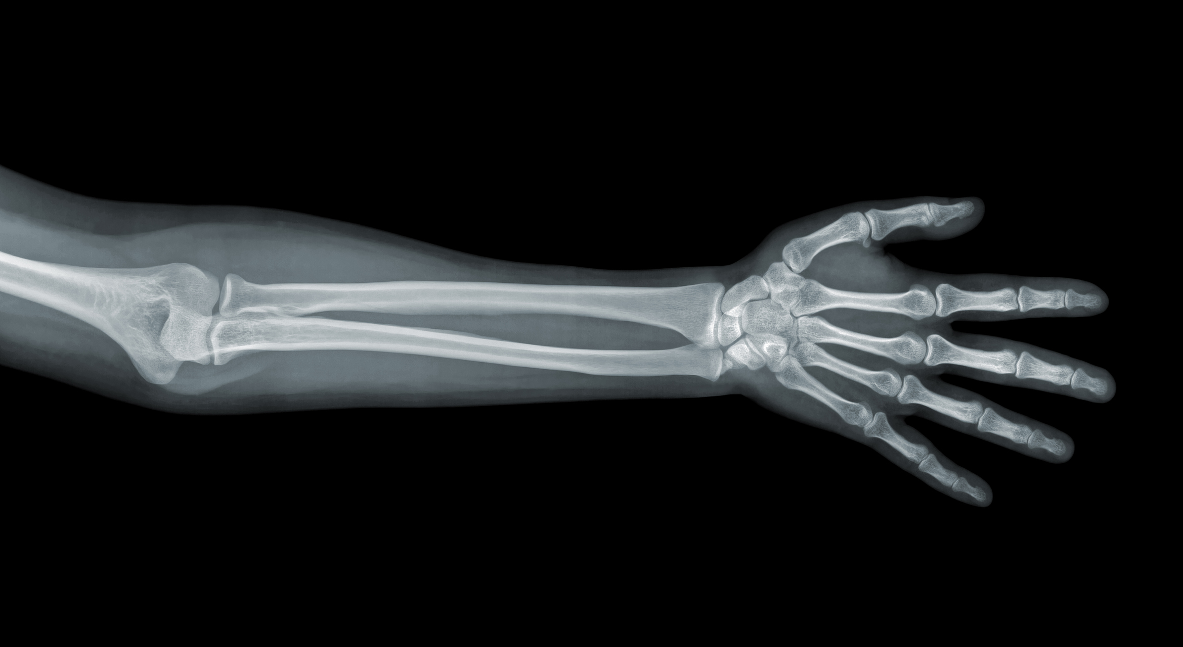 x-ray showing the bones of the arm and hand