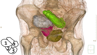 CT scan of a mummy showing the pelvic skeleton and four objects inside, each shaded a different color