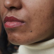 close up of woman with cheek and chin acne