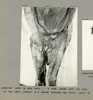 A picture of the mummy with a fetus lodged between its legs.