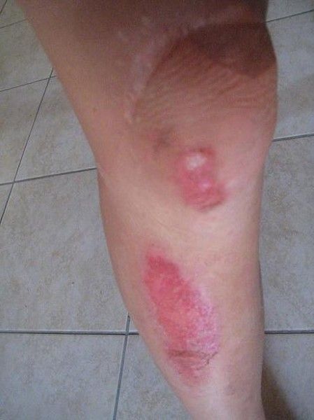 Peta's leg after the training ride crash