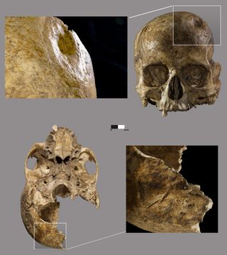 On the upper left side of the possibly-female skull, archaeologists found a small divot, which could indicate where "surgeons" drilled a hole through her skull in a brain-surgery practice called trepanation.