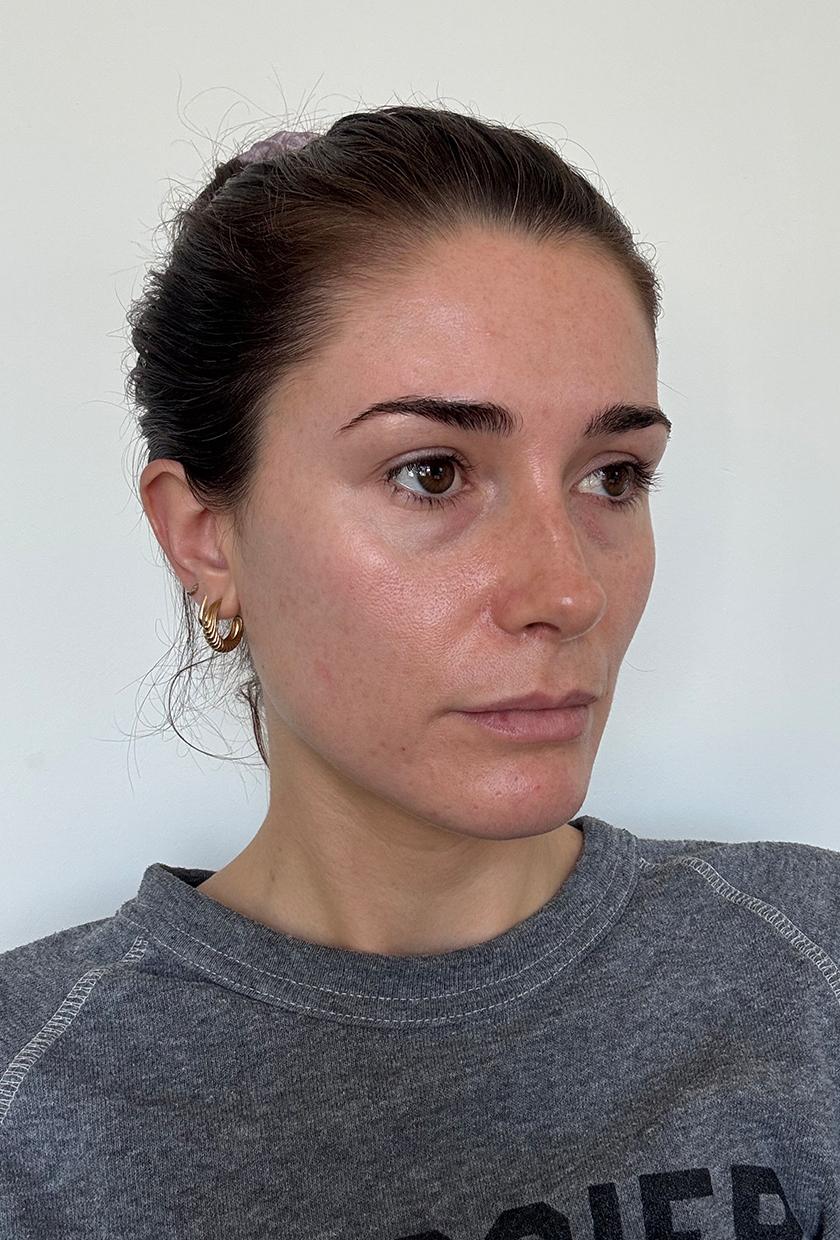 A 'before' picture of beauty editor Eleanor before using the Medik8 eye cream two months ago