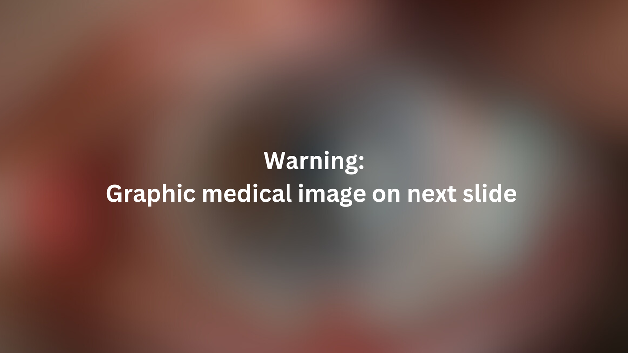White text is written across a blurred image of the patients' eye. The text reads "Warning: Graphic medical image on next slide"