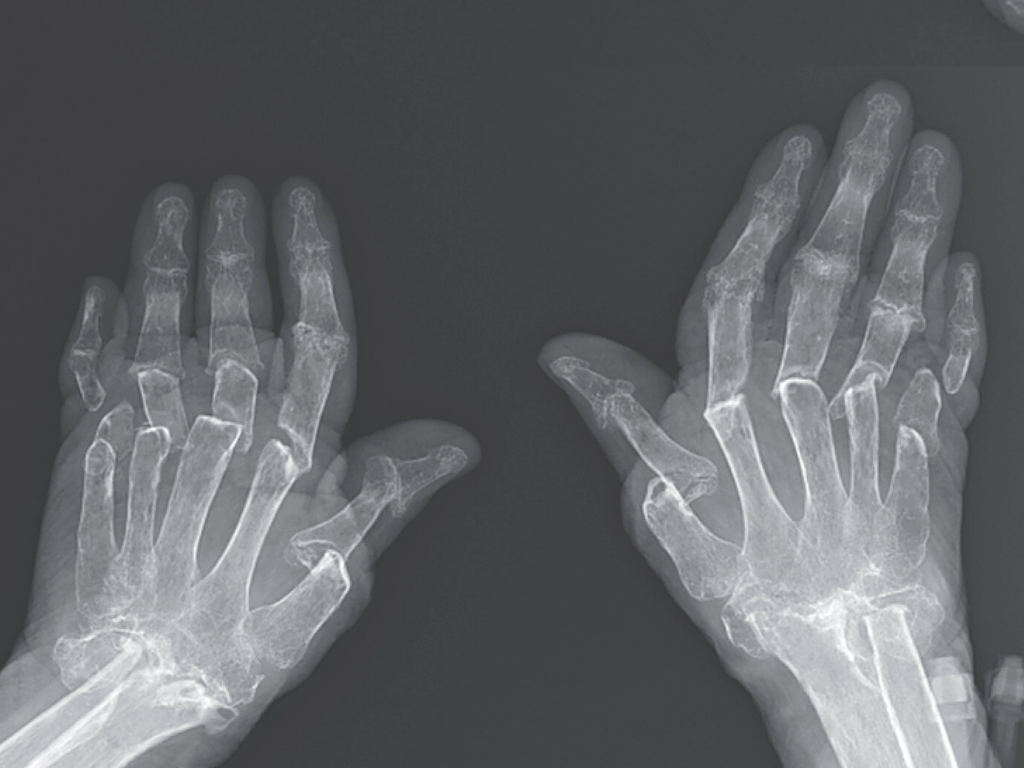 a radiograph of the woman&#039;s hands