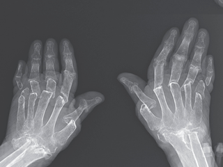 a radiograph of the woman's hands