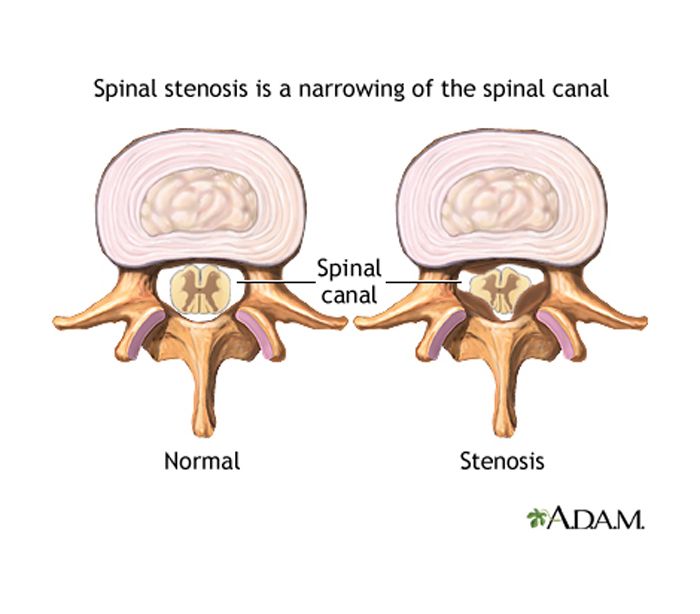 Spinal Stenosis (Cervical)  Central Coast Orthopedic Medical Group