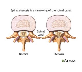 Spinal Stenosis Symptoms Treatment Live Science