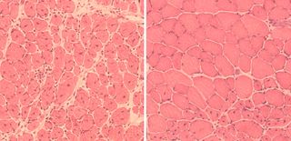 On the left, muscle cells from old mice that have an impaired ability to repair themselves. On the right, muscle cells from old mice after treatment with "reprogramming factors," which improved muscle regeneration.