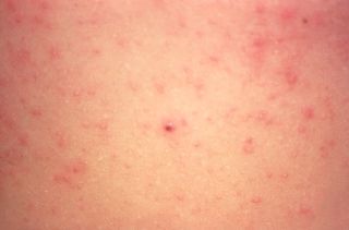 A scabies infection often appears as little red bumps or blisters on the skin.
