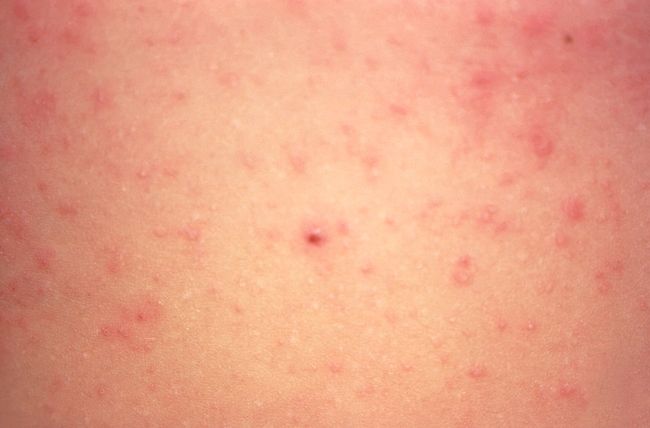 Scabies: Causes, Symptoms & Treatment | Live Science