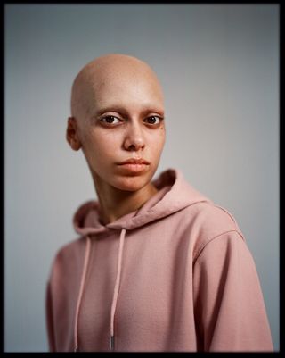 A young woman with no hair wearing a pink hoodie