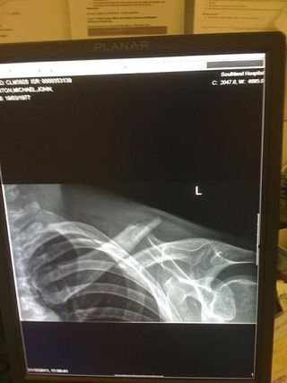 The X-ray shows just how close the bone got.