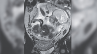 MRI scan of a woman's abdomen shows a black arrow pointing at the outlined head of a fetus