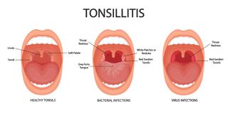 Infographic drawing diagram of health tonsils, tonsils infected by bacteria, and tonsils infected by a virus. The infected tonsils are larger and redder.