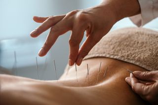 A colse up of acupuncture on a woman's back